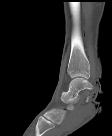 Chopart fracture (Radiopaedia 35347-36851 Sagittal bone window 24).jpg