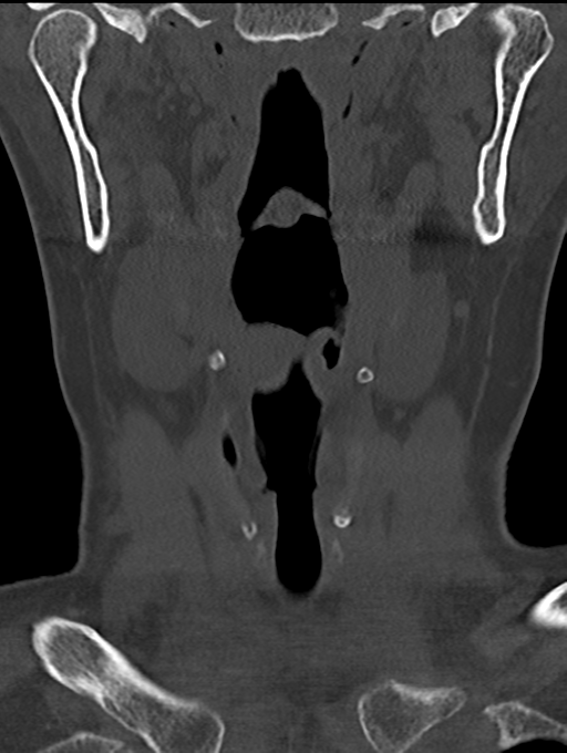Chordoma (C4 vertebra) (Radiopaedia 47561-52188 Coronal bone window 3).png