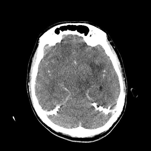 File:Choriocarcinoma of ovary with cerebral and pulmonary metastases (Radiopaedia 25983-26118 C+ arterial phase 65).jpg