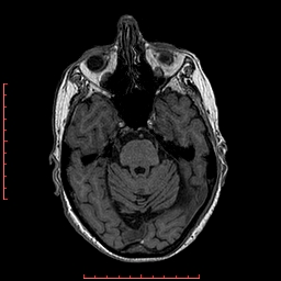 Choroid plexus xanthogranuloma (Radiopaedia 67843-77270 Axial T1 114).jpg