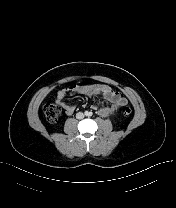 Chromophobe renal cell carcinoma (Radiopaedia 84255-99542 F 45).jpg