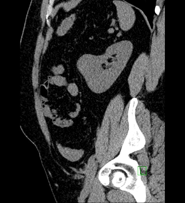 Chromophobe renal cell carcinoma (Radiopaedia 84286-99573 C 46).jpg