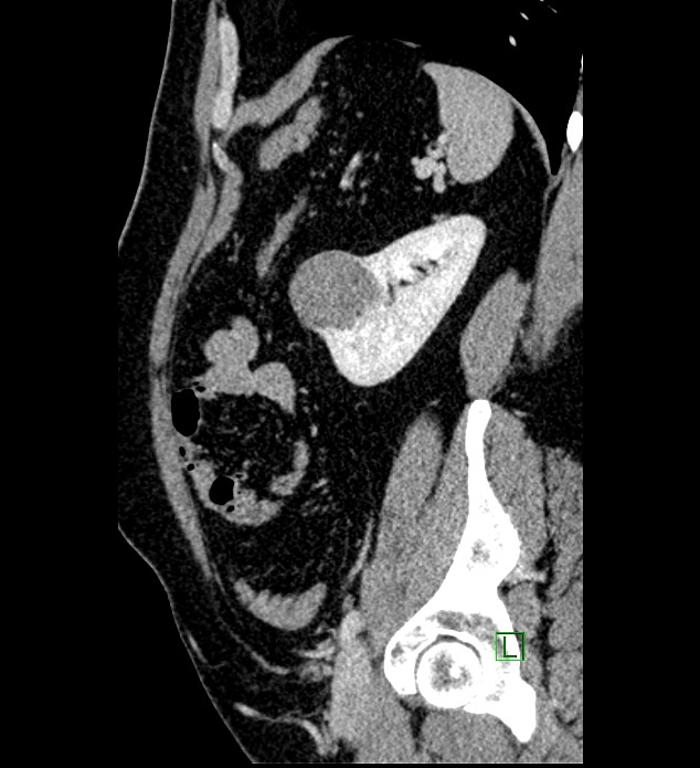 Chromophobe renal cell carcinoma (Radiopaedia 84286-99573 I 46).jpg