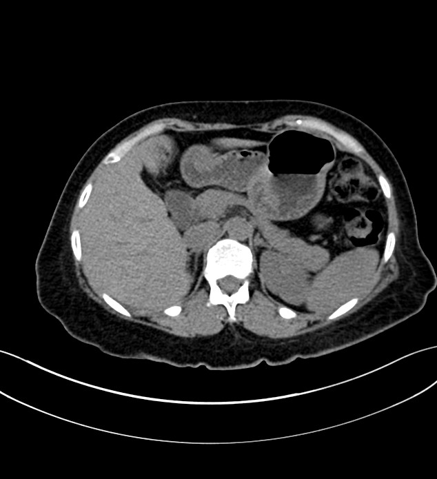 Chromophobe renal cell carcinoma (Radiopaedia 84290-99582 Axial non-contrast 42).jpg