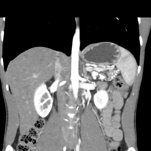 File:Chronic calcific pancreatitis (Radiopaedia 56280-62953 E 16).jpg