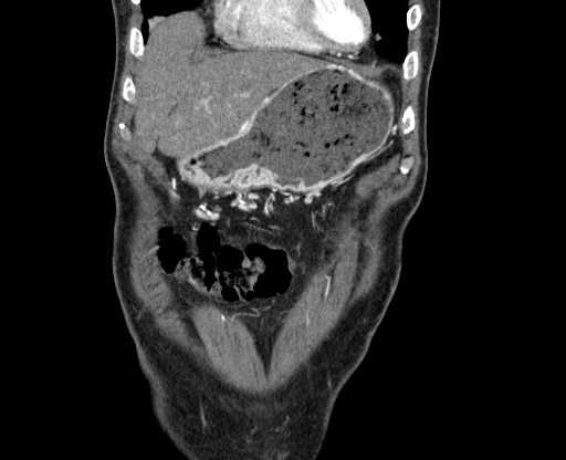 File:Chronic contained rupture of abdominal aortic aneurysm with extensive erosion of the vertebral bodies (Radiopaedia 55450-61901 D 1).jpg