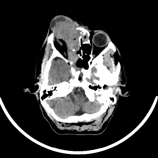 File:Chronic invasive fungal sinusitis with intraorbital and intracranial extension (Radiopaedia 56387-63046 Axial non-contrast 118).jpg