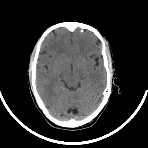 File:Chronic invasive fungal sinusitis with intraorbital and intracranial extension (Radiopaedia 56387-63046 Axial non-contrast 177).jpg