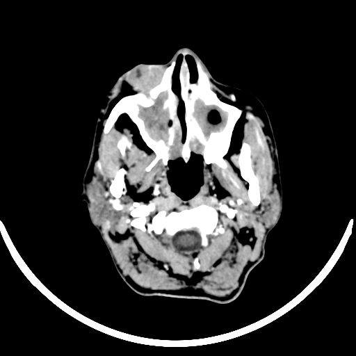 Chronic invasive fungal sinusitis with intraorbital and intracranial extension (Radiopaedia 56387-63046 B 29).jpg
