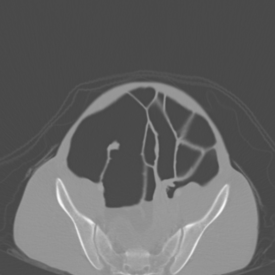 Chronic large bowel pseudo-obstruction (Radiopaedia 43181-46492 Axial bone window 137).jpg