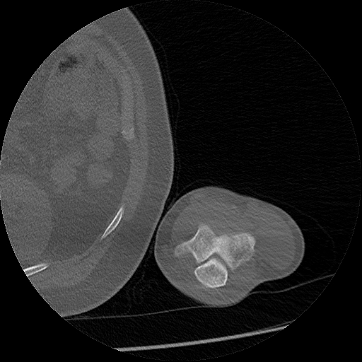 Chronic osteomyelitis (Radiopaedia 67597-76998 Axial bone window 72).jpg