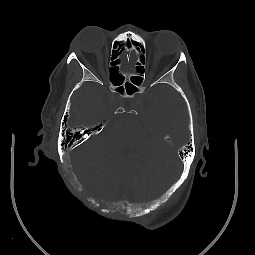 Chronic osteomyelitis - calvarial (severe) (Radiopaedia 69668-79616 Axial bone window 36).jpg