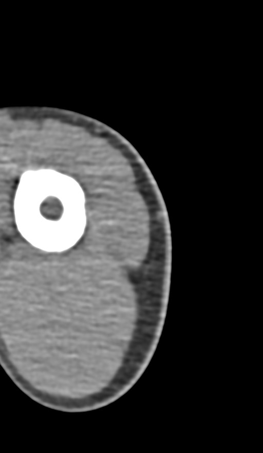 Chronic osteomyelitis of the distal humerus (Radiopaedia 78351-90971 Axial non-contrast 5).jpg