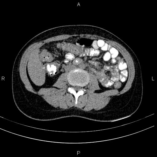 File:Chronic pancreatitis (Radiopaedia 64576-73450 Axial non-contrast 85).jpg