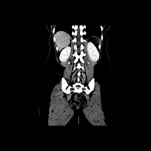 Chronic portal venous thrombosis with cavernous transformation (Radiopaedia 73618-84398 B 85).jpg