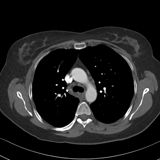 Chronic pulmonary embolus (Radiopaedia 39129-41341 Axial C+ CTPA 38).png