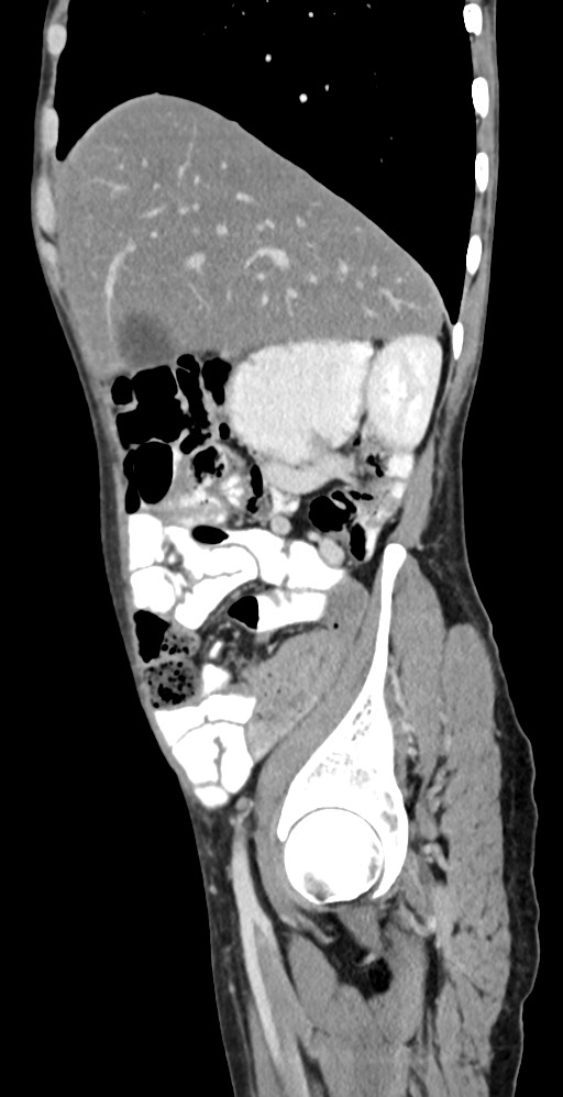 Chronic small bowel volvulus (Radiopaedia 75224-86322 C 110).jpg