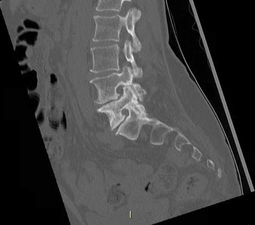 File:Chronic spinal hematoma with cauda equina syndrome (Radiopaedia 75745-88197 Sagittal bone window 20).png