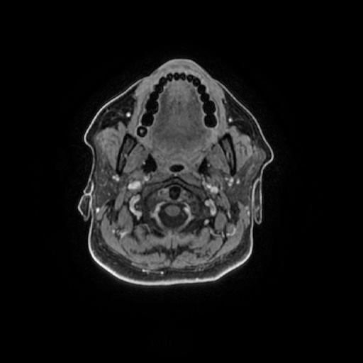 Chronic submandibular sialadenitis (Radiopaedia 61852-69885 Axial T1 C+ fat sat 87).jpg