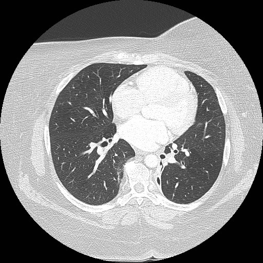 Cicatrisation collapse (Radiopaedia 17405-17089 lung window 62).jpg