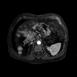 File:Cirrhosis and hepatocellular carcinoma in the setting of hemochromatosis (Radiopaedia 75394-86594 Axial T1 C+ fat sat 133).jpg