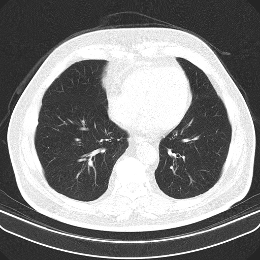 File:Classic complicated silicosis (Radiopaedia 49720-54961 Axial lung window 39).jpg
