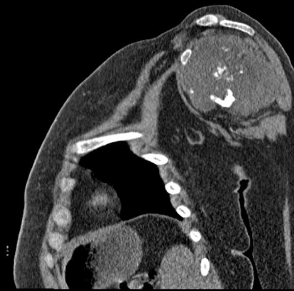 File:Clear cell chondrosarcoma - humerus (Radiopaedia 63104-71612 D 31).jpg