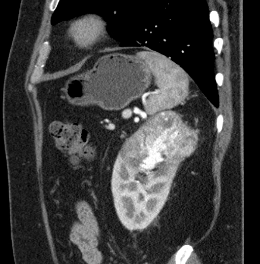 File:Clear cell renal cell carcinoma (Radiopaedia 61449-69393 D 17).jpg