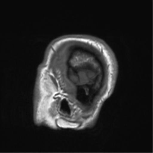 Clival chordoma invading the hypoglossal canal (Radiopaedia 48850-53887 Sagittal T1 86).png