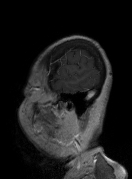 Clival meningioma (Radiopaedia 53278-59248 Sagittal T1 C+ 145).jpg