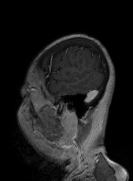 File:Clival meningioma (Radiopaedia 53278-59248 Sagittal T1 C+ 150).jpg