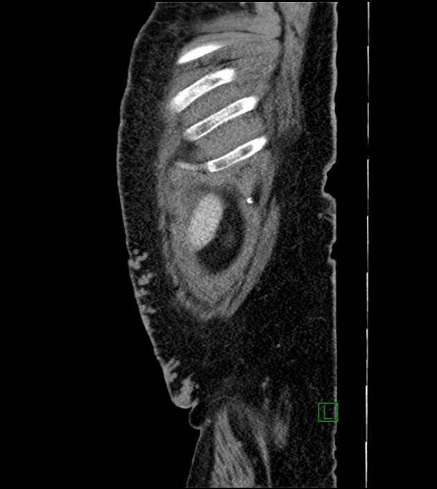Closed-loop small bowel obstruction-internal hernia (Radiopaedia 78439-91096 C 18).jpg
