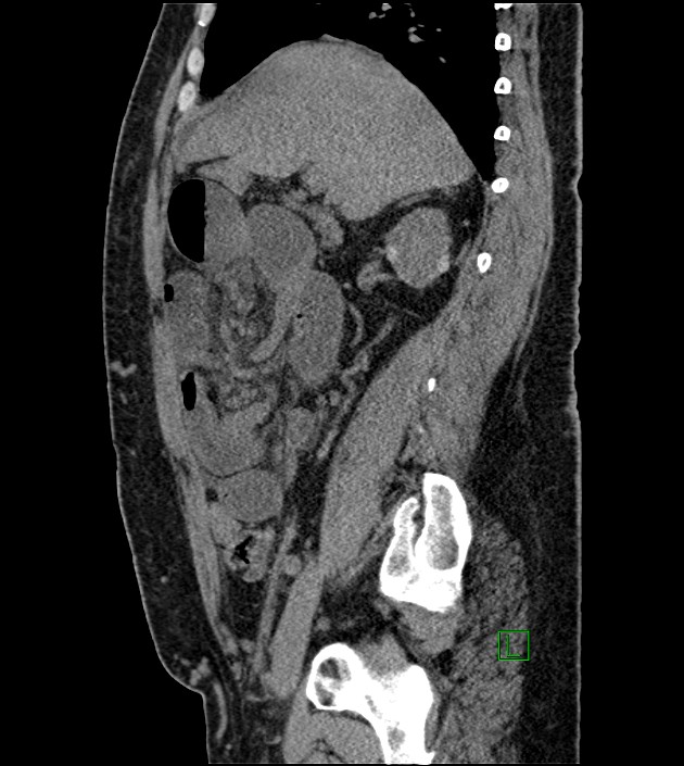 Closed-loop small bowel obstruction-internal hernia (Radiopaedia 78439-91096 C 94).jpg