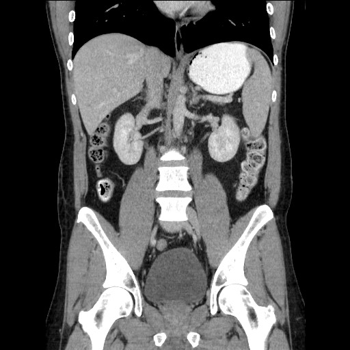 Closed-loop small bowel obstruction (Radiopaedia 73713-84509 C 71).jpg