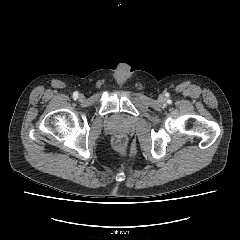 Closed loop bowel obstruction and ischemia (Radiopaedia 86959-103180 A 90).jpg