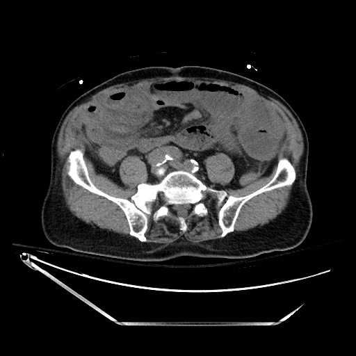File:Closed loop obstruction due to adhesive band, resulting in small bowel ischemia and resection (Radiopaedia 83835-99023 Axial non-contrast 104).jpg