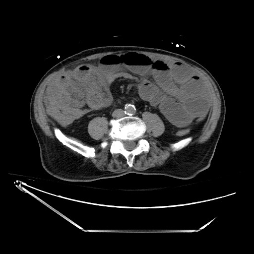 Closed loop obstruction due to adhesive band, resulting in small bowel ischemia and resection (Radiopaedia 83835-99023 Axial non-contrast 93).jpg