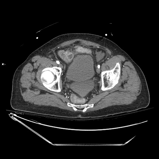 File:Closed loop obstruction due to adhesive band, resulting in small bowel ischemia and resection (Radiopaedia 83835-99023 B 137).jpg