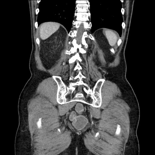 Closed loop obstruction due to adhesive band, resulting in small bowel ischemia and resection (Radiopaedia 83835-99023 E 102).jpg