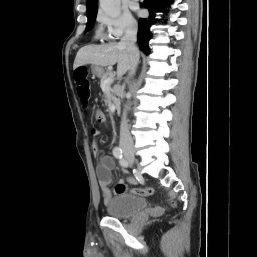 Closed loop small bowel obstruction (Radiopaedia 59227-66554 C 30).jpg