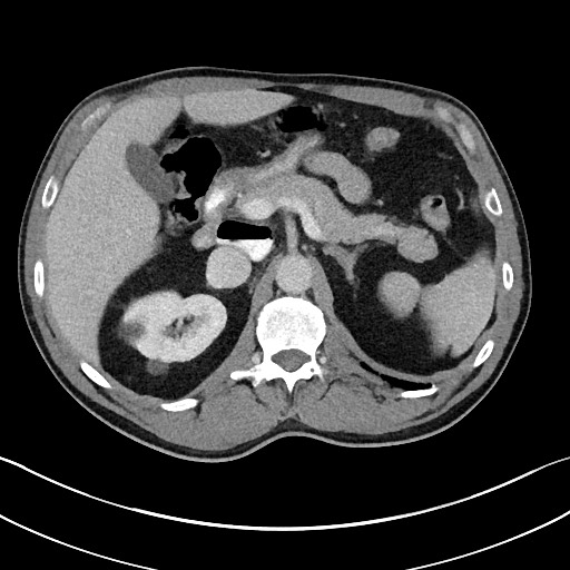 Closed loop small bowel obstruction - internal hernia (Radiopaedia 57806-64778 B 37).jpg