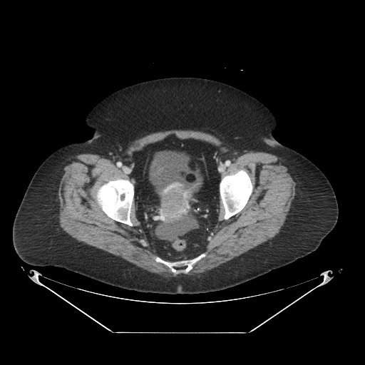 Closed loop small bowel obstruction - internal hernia (Radiopaedia 65402-74450 A 120).jpg