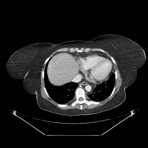 Closed loop small bowel obstruction - internal hernia (Radiopaedia 65402-74450 A 5).jpg