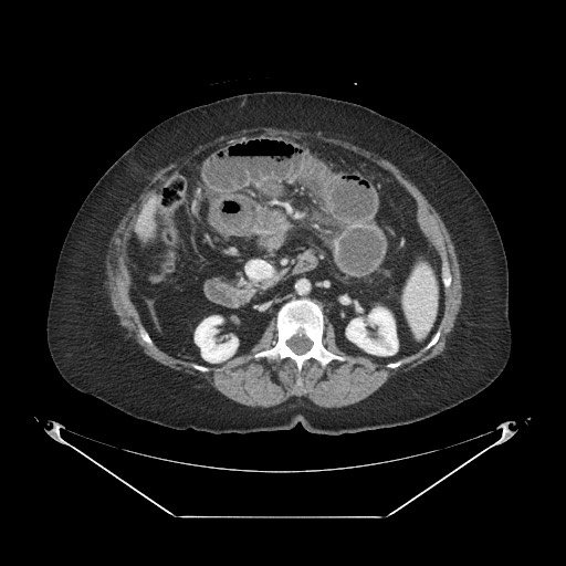 Closed loop small bowel obstruction - internal hernia (Radiopaedia 65402-74450 A 52).jpg