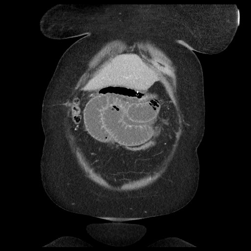 Closed loop small bowel obstruction - internal hernia (Radiopaedia 65402-74450 B 19).jpg