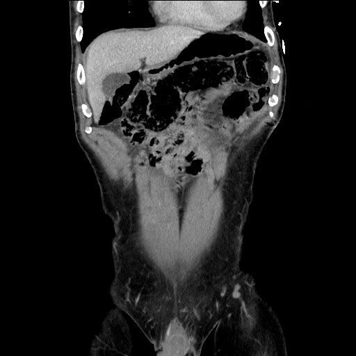 File:Closed loop small bowel obstruction - omental adhesion causing "internal hernia" (Radiopaedia 85129-100682 B 36).jpg
