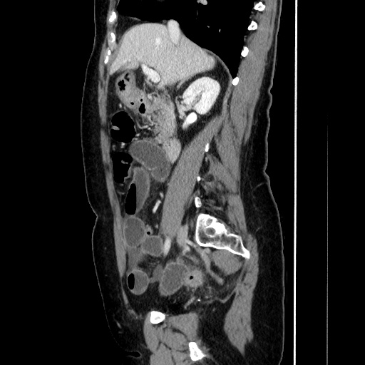 Closed loop small bowel obstruction due to adhesive bands - early and late images (Radiopaedia 83830-99015 C 73).jpg