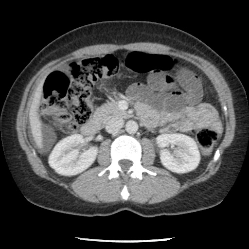 File:Closed loop small bowel obstruction due to trans-omental herniation (Radiopaedia 35593-37109 A 37).jpg