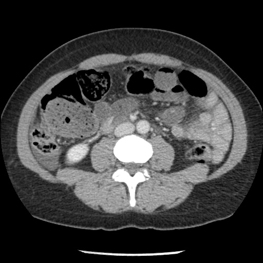 File:Closed loop small bowel obstruction due to trans-omental herniation (Radiopaedia 35593-37109 A 47).jpg