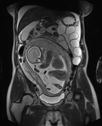 File:Closed loop small bowel obstruction in pregnancy (MRI) (Radiopaedia 87637-104031 Coronal T2 27).jpg